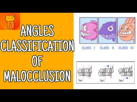 Angle classification of malocclusion in only 10 mins --detailed video -- explained with pictures