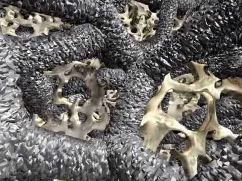 Zimmer Dental -Trabecular Metal Implant animacija.wmv