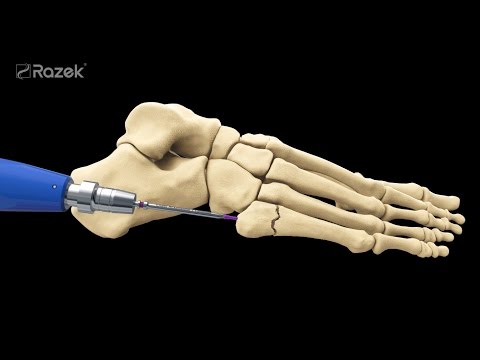 Osteocondrosi del decorso della malattia toracica Maggiore accumulo di radiotracer nelle articolazioni