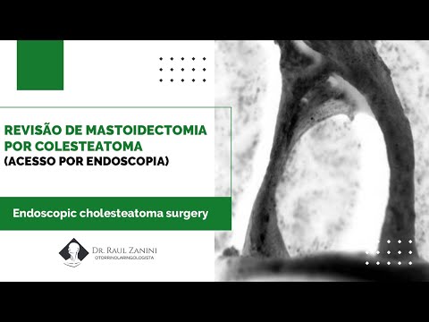 Miniatura: Revisão endoscópica de mastoidectomia por reicidiva de colesteatoma