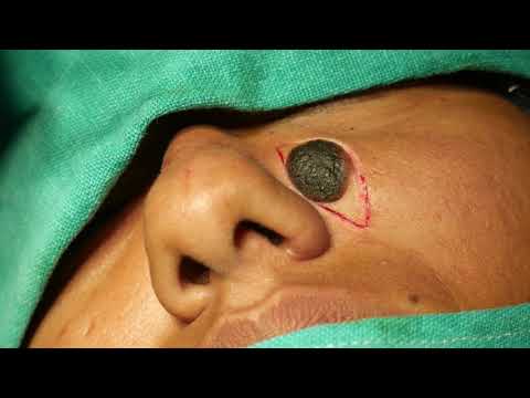 Giant Facial Mole Removed Permanently - Surgical Method