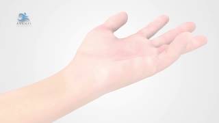 Cirugía Sin Abrir de la Enfermedad de Dupuytren