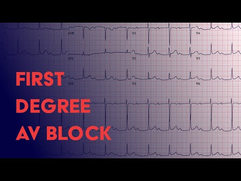 First Degree AV Block -  EKG (ECG) Interpretation