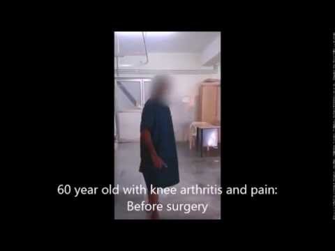 Knee replacement in Chennai