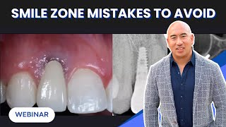 Smile Zone Mistakes You Don’t Want to Make | Immediate Implants