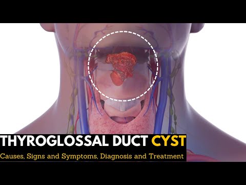Thyroglossal Duct Cyst Causes Signs and Symptoms Diagnosis and Treatment