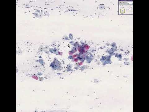Cervix     High grade squamous intraepithelial lesion HSIL, Pap smear