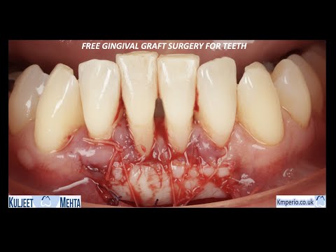 Free Gingival Graft Surgery