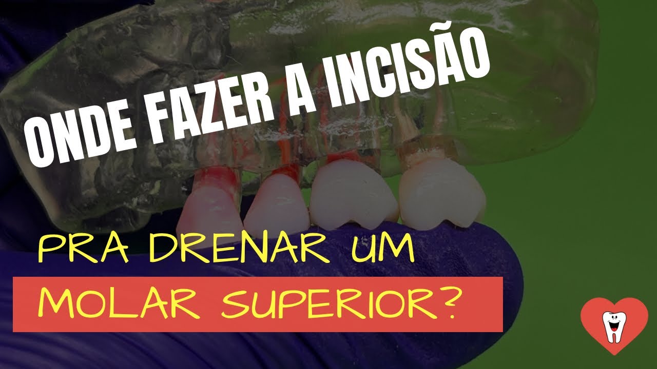 ONDE FAZER A INCISÃO PRA DRENAR UM ABSCESSO EM MOLAR SUPERIOR?