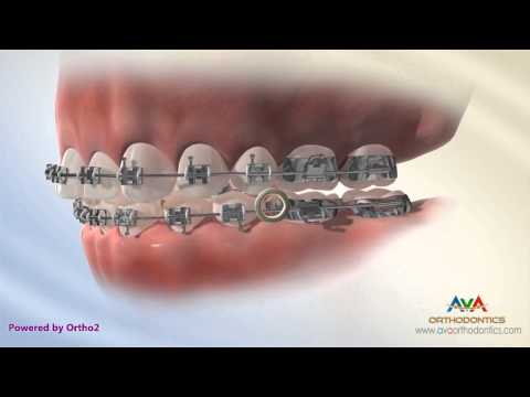 How to wear Rubber Bands - Crossbite Upper 6 Lower 6