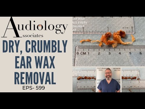 DRY, CRUMBLY EAR WAX REMOVAL - EP599
