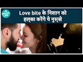 Love Bite के निशान तुरंत ऐसे करें हलके How To Remove L