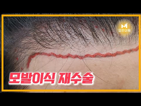 비절개 모발이식 재수술 하는김에  추가수술?