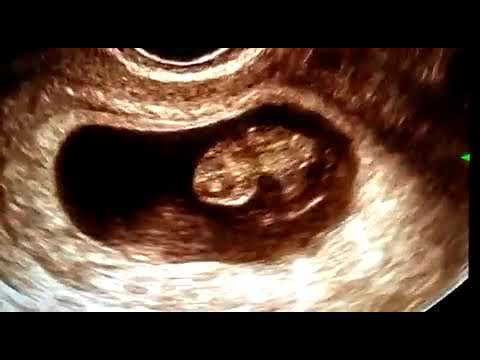 Normal rhombencephalon in 9 weeks fetus