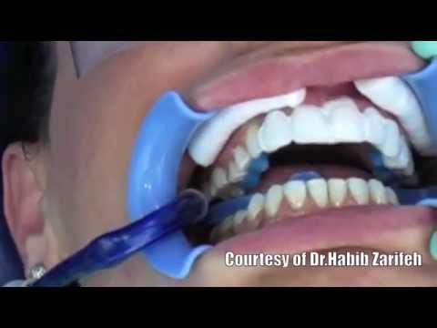 download lagu mp3 mp4 Hollywood Smile Laser, download lagu Hollywood Smile Laser gratis, unduh video klip Hollywood Smile Laser