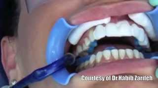 Lumineers Hollywood smile veneers cosmetic dentistry step by step by Dr.Habib Zarifeh