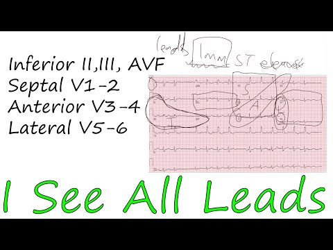 How To Read ECG Step By Step Part 3 of 3 (12 lead interpretation)