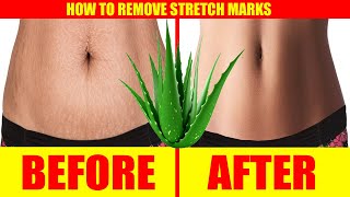 Stretch Marks Removal At Home – How to Remove Stretch Marks after Pregnancy | Natural Home Remedy