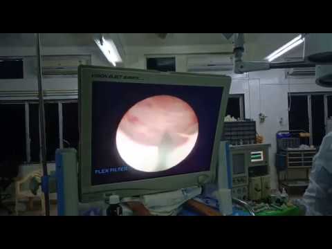 Endoscopic ablation of Posterior Urethral Valve