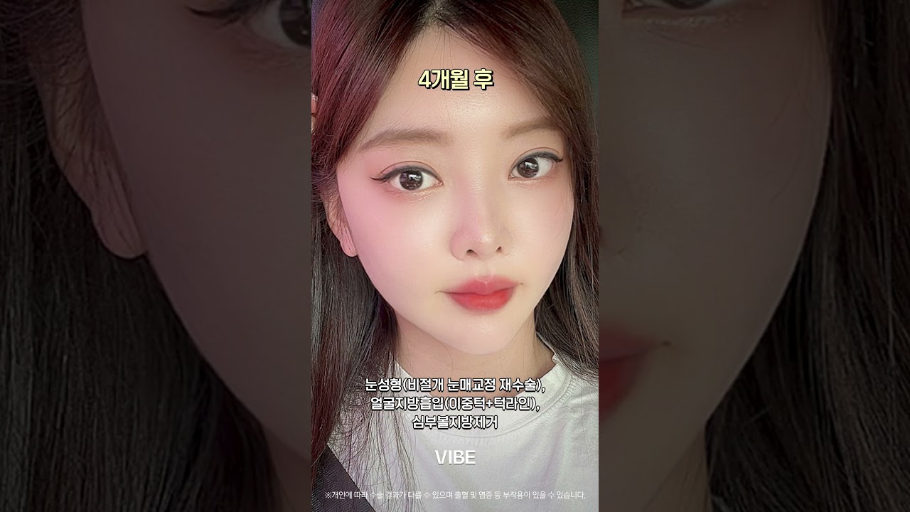 눈성형(비절개 눈매교정 재수술), 얼굴지방흡입(이중턱+턱라인), 심부볼지방제거