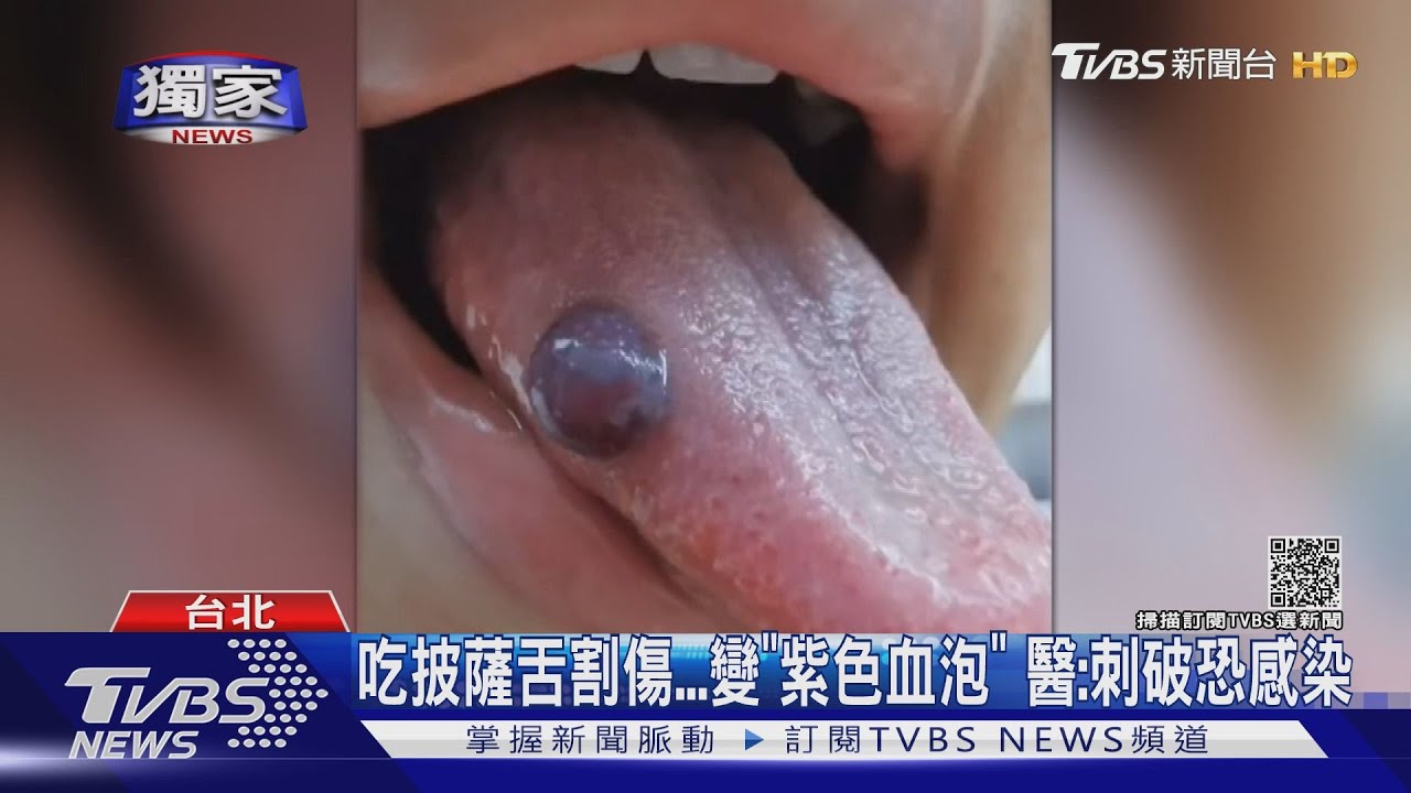 吃披薩舌割傷　變「紫色血泡」醫：刺破恐感染