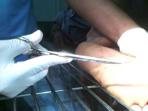 ยาจีนโรคผิวหนังภูมิแพ้ กลาก seborrheic บนหัว