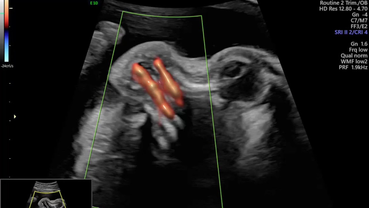 AVALIAÇÃO DE FENDA PALATINA EM FETO DE 30 SEMANAS