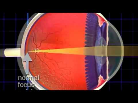 Milyen kezelés a szem számára, ha rövidlátás
