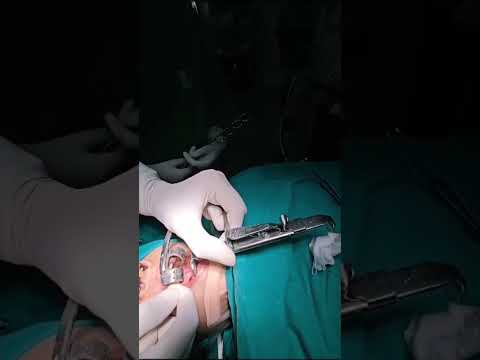 Dental Mouth Gag