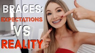 BRACES: EXPECTATIONS vs REALITY