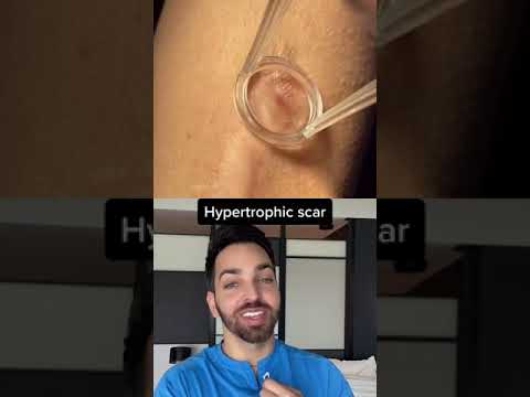 Dr. Shah Reacts to Scar Treatment #shorts