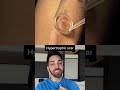 Dr. Shah Reacts to Scar Treatment #shorts