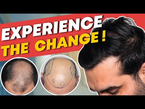 Hair Transplant in Dubai | Best Results & Cost of Hair...