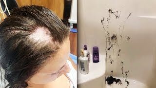 Girl Goes Bald Because Sadist Puts Nair In Shampoo