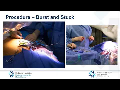 Snare, retrieval, and a save_Pasala_Structural On Demand