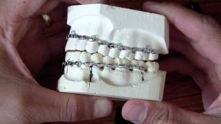 Wiring Fractured Jaw - Erich Arch Bars
