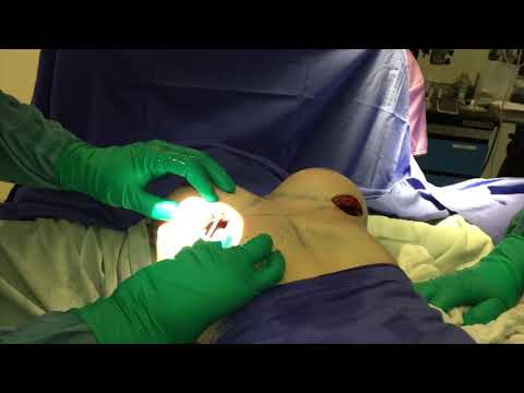 download lagu mp3 mp4 Implantes De Senos En Tijuana, download lagu Implantes De Senos En Tijuana gratis, unduh video klip Implantes De Senos En Tijuana