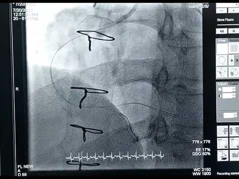 Anterograde opening of mid RCA CTO (ISR) in a post CABG patient (Occluded PDA graft)