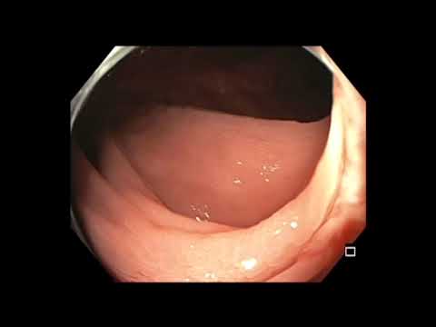 Colonoscopy: How to Document and Resect Small Polyps