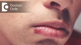 What can cause blisters near corner of mouth? - Dr. Srivats Bharadwaj