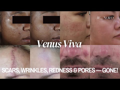 Venus Viva Explained: Skin Resurfacing for Scars, Wrinkles & Pores (Safe for All Skin Types!