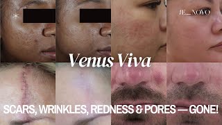 Venus Viva Explained: Skin Resurfacing for Scars, Wrinkles & Pores (Safe for All Skin Types!
