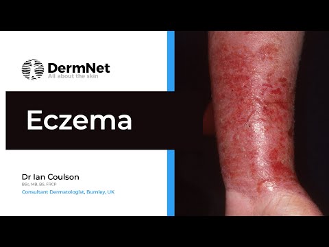 Eczema: A Complete Overview