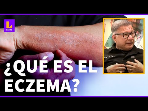 , title : 'Qué es ECZEMA en la piel: cómo se cura y causas'