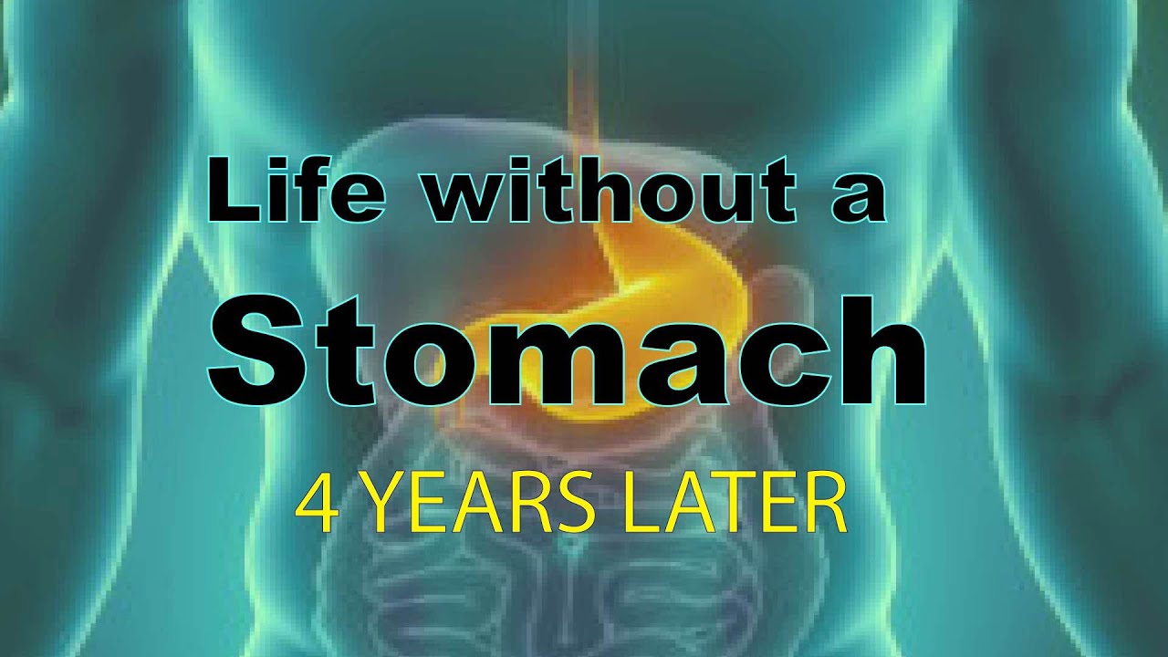 Esophagectomy 4 years later