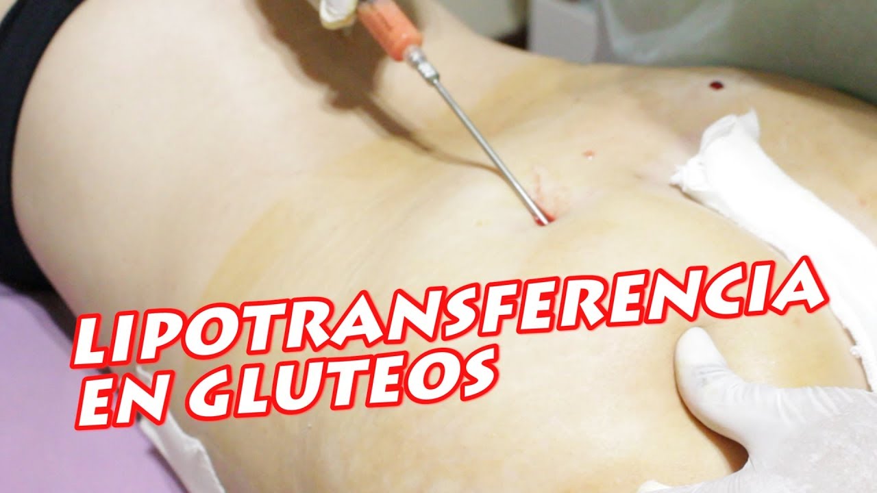 LIPOTRANSFERENCIA EN GLUTEO: una alternativa para aumento de gluteos