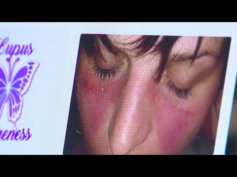 Five surprising symptoms of lupus