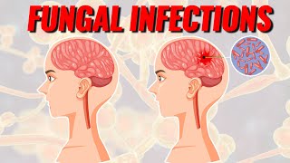 Deadly Fungal Infections Spreading