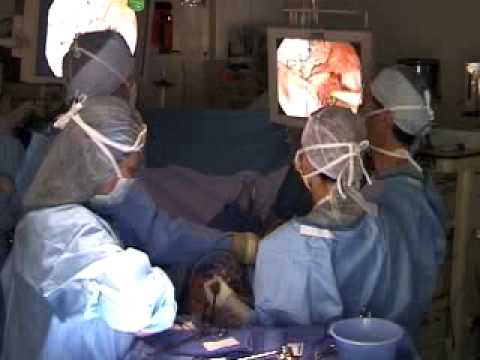 Video Assisted Thoracic Surgery (VATS)