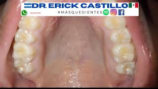 Mira este paladar ¿te ha pasado algo similar